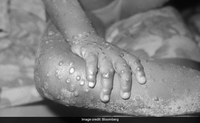 80 Monkeypox cases confirmed in 11 countries